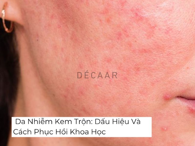 da nhiễm kem trộn